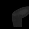 SPORK, NICO - 22.03.1976 - 02.08.2022 - CT obere Extremität - 17:59:07